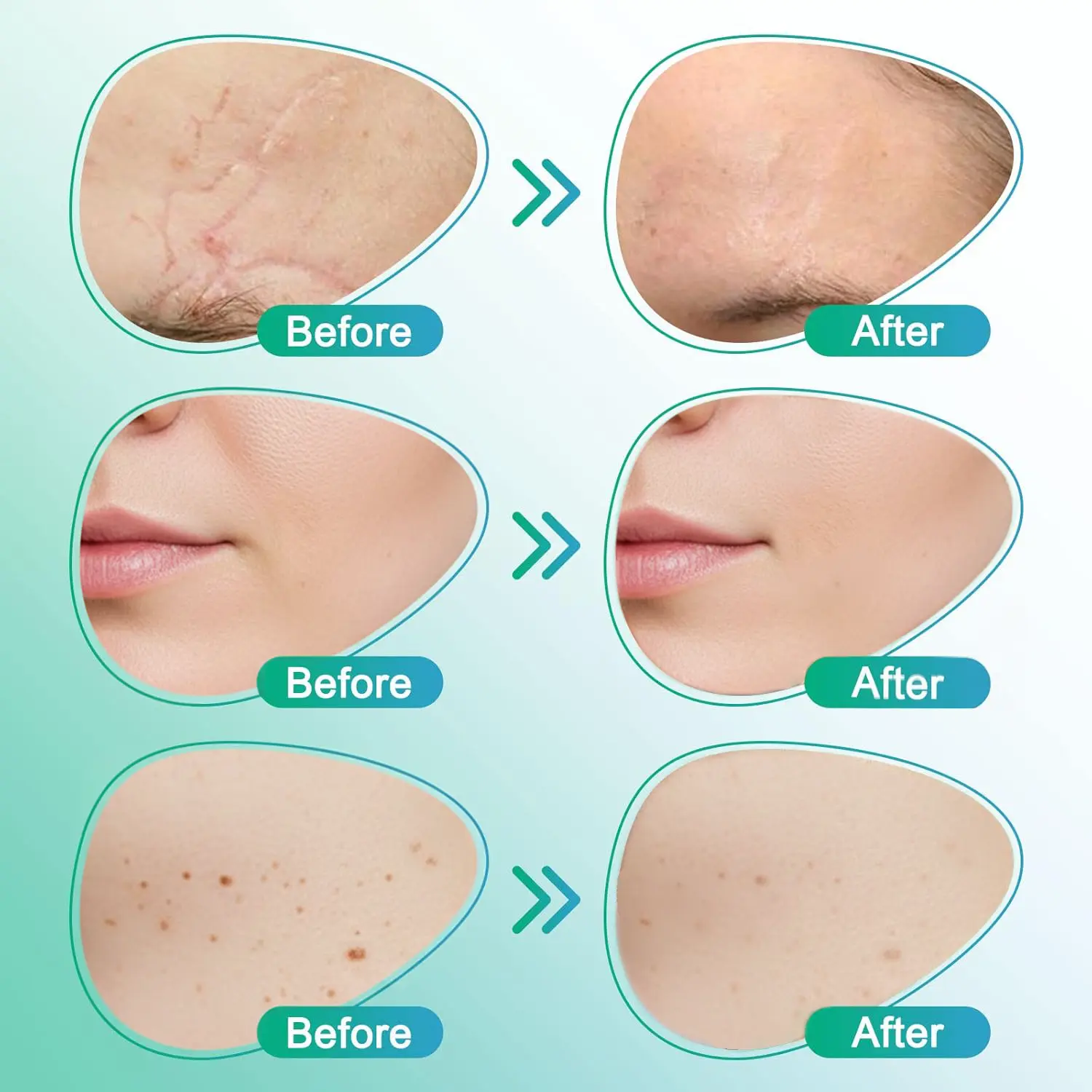 𝗖𝗮𝗿𝗲𝗕𝗿𝗲𝗲𝘇𝗲® 3-in-1 Microneedle Care Patch - Image 5