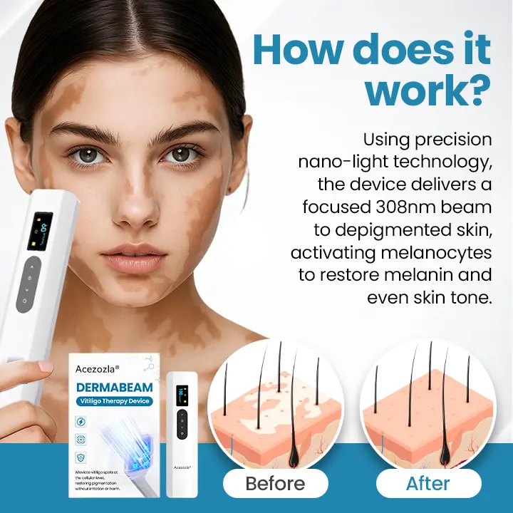 Acezozla® DermaBeam Vitiligo-hoitolaite - Image 3
