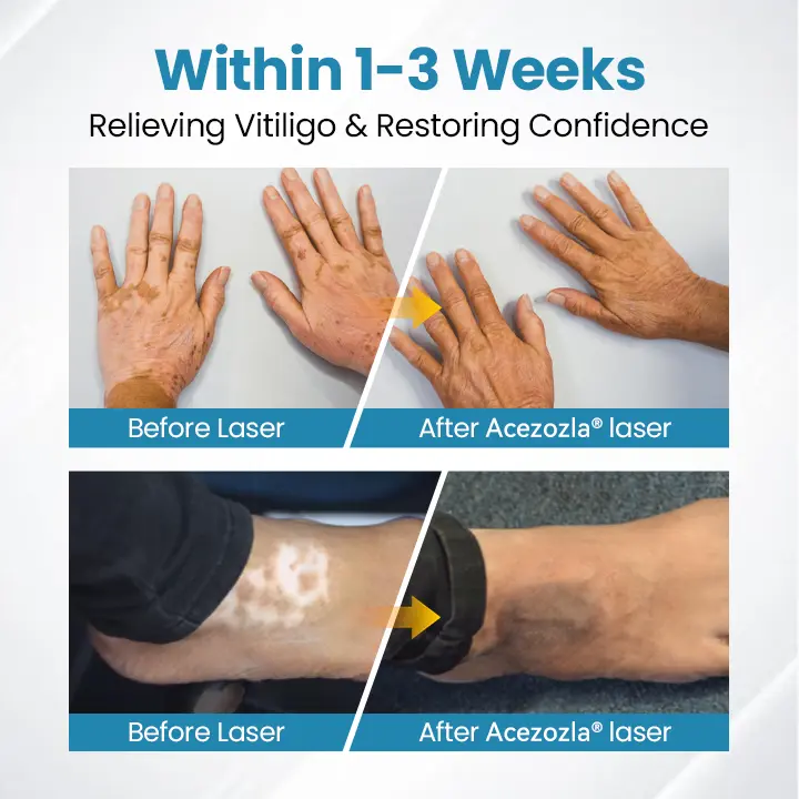 Acezozla® DermaBeam Vitiligo-hoitolaite - Image 4