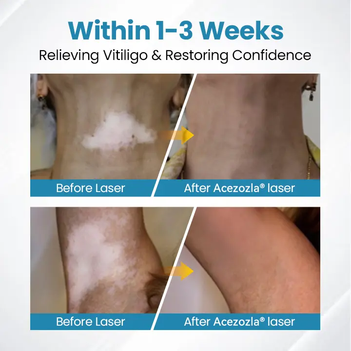 Acezozla® DermaBeam Vitiligo-hoitolaite - Image 5