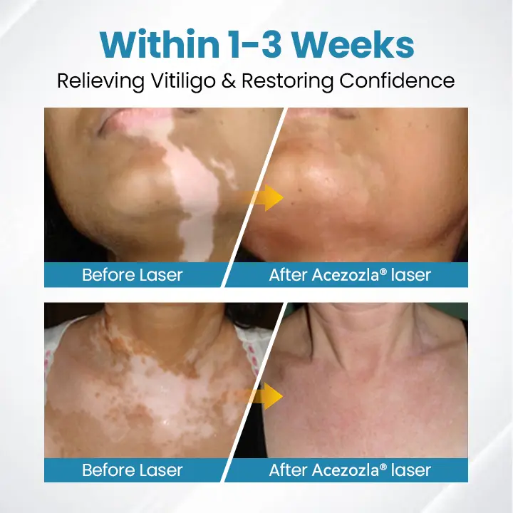 Acezozla® DermaBeam Vitiligo-hoitolaite - Image 7